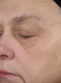 Apr&egrave;s avoir utilis&eacute; le Retinol 0,3 % de Mary Kay Clinical Solutions